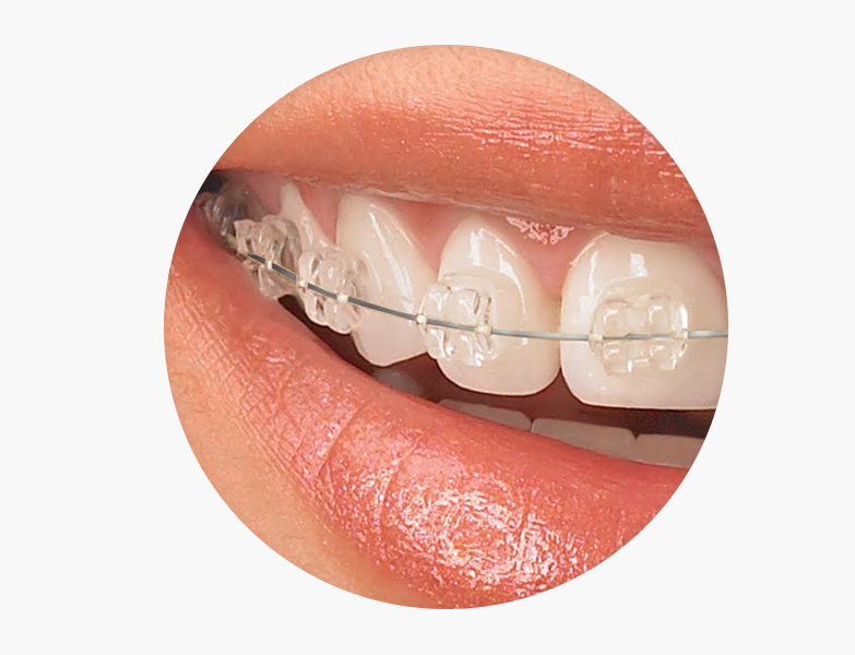 Ortodoncia Brackets Metalicos