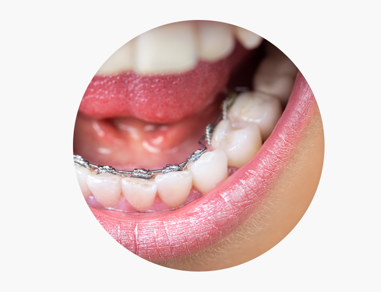 Ortodoncia Brackets Metalicos